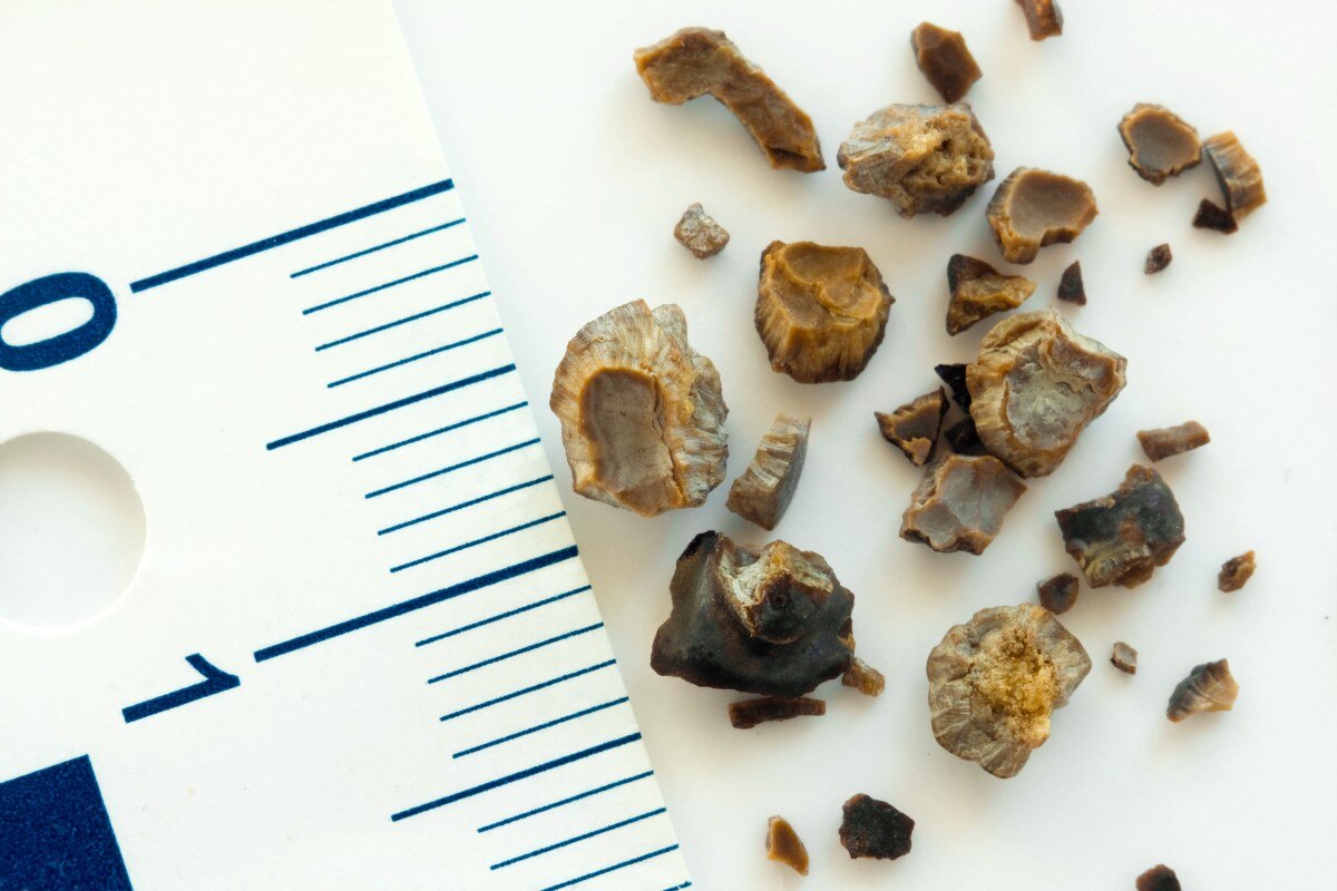 Kidney stones after ESWL intervention. Lithotripsy. Macro shot; Shutterstock ID 116071294; Business Unit: Jones & Bartlett Learning; Project Name: ATI Fundamentals; ISBN or Project Number: ATI FUND; Element Number: Multiple images in Lesson-31, 32 & 34