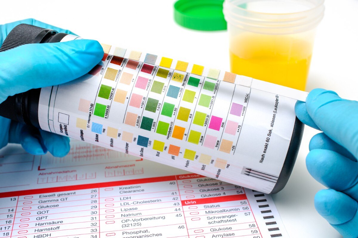 Medical exam, Hands with the urine test strip