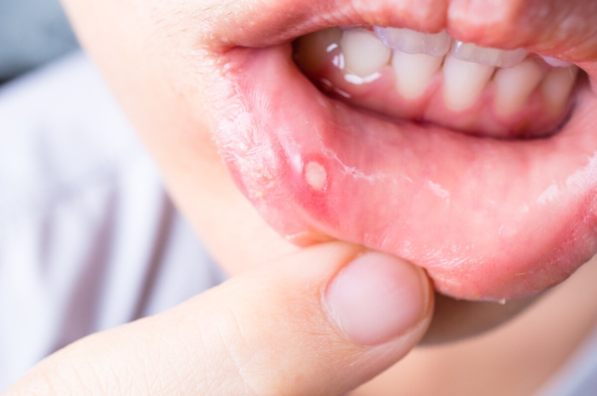 Close-up of client with an oral aphthous ulcer on lip 